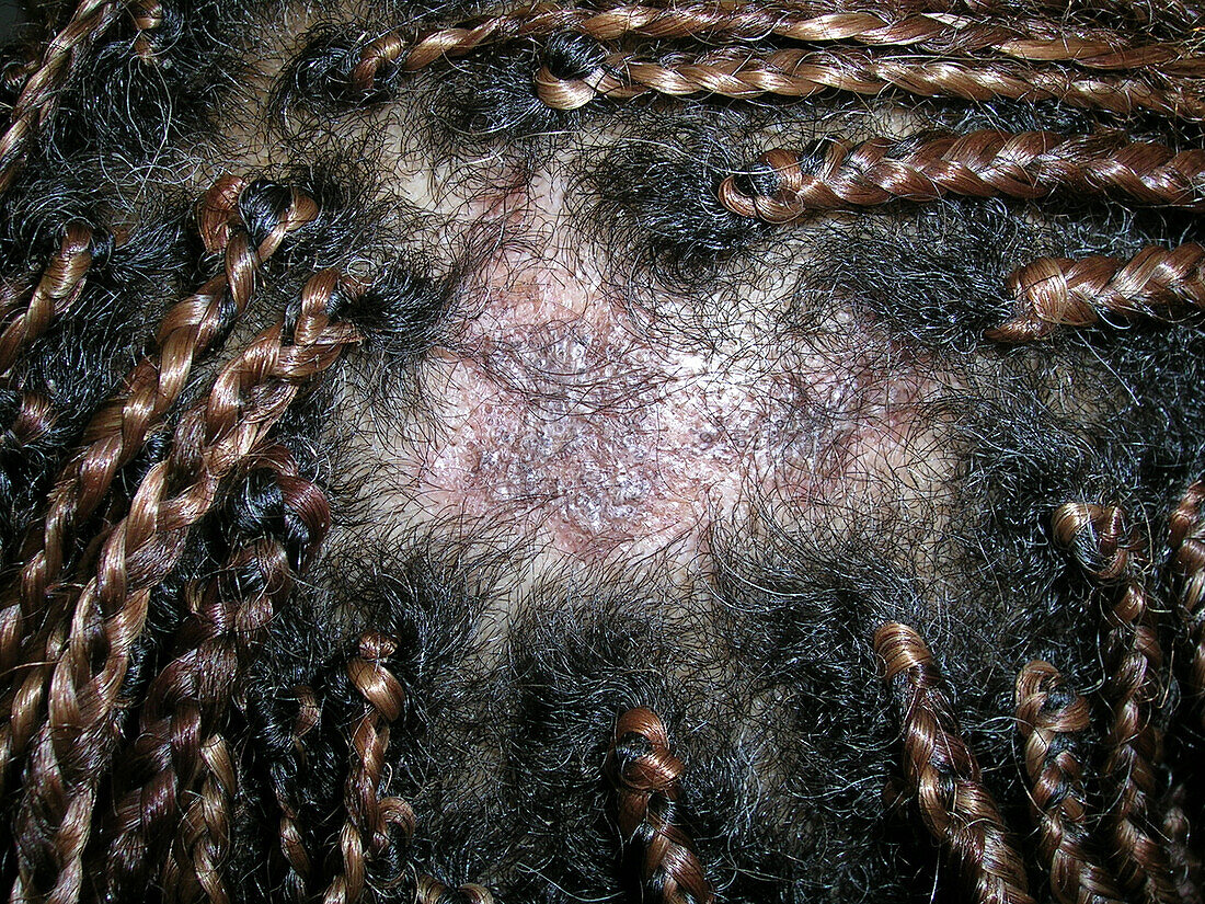 Scarring alopecia