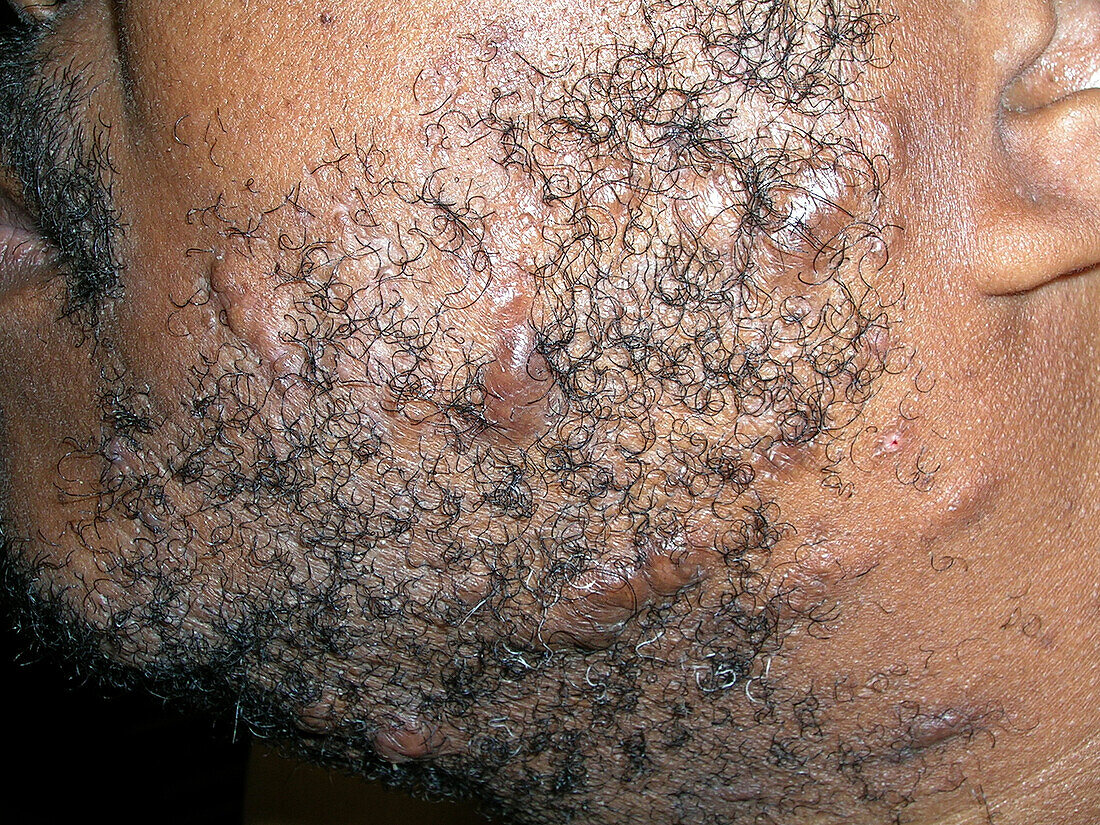 Hidradenitis suppurativa