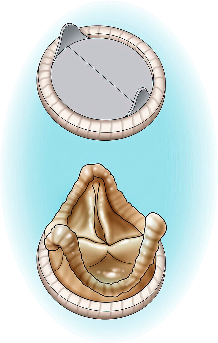 Aortic valve replacements, illustration