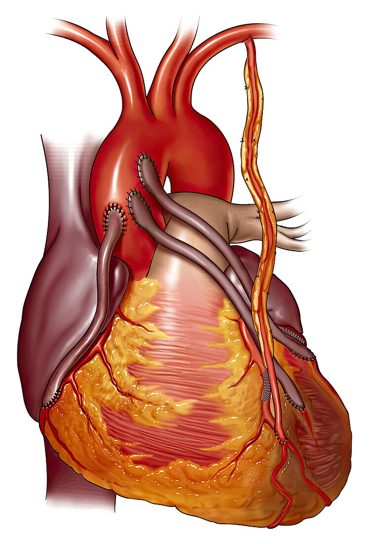 Heart attack with bypass, illustration