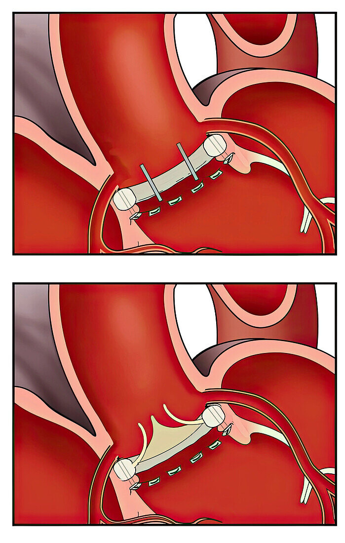 Aortic valve replacement, illustration