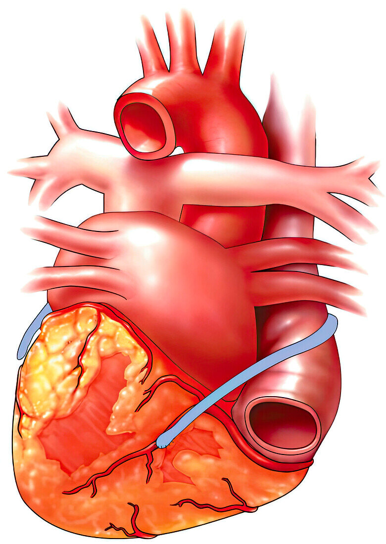 Saphenous vein graft, illustration