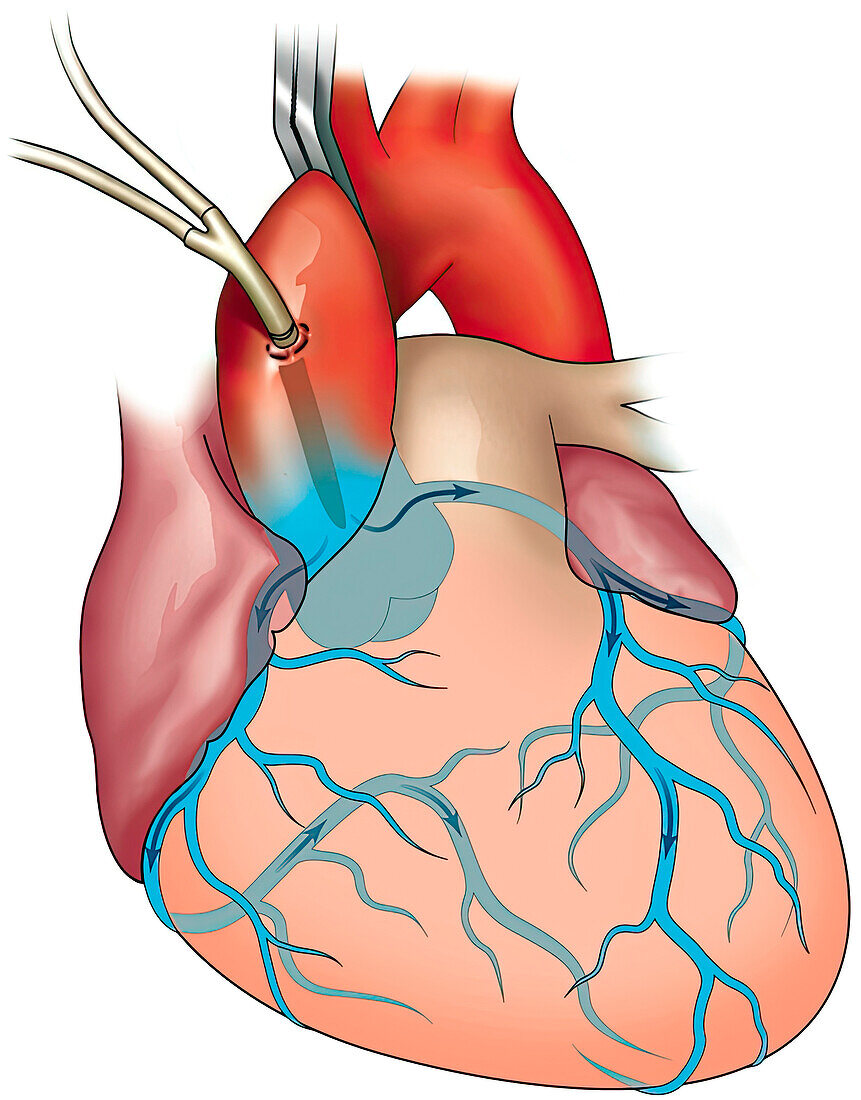 Cardiac angiogram, illustration