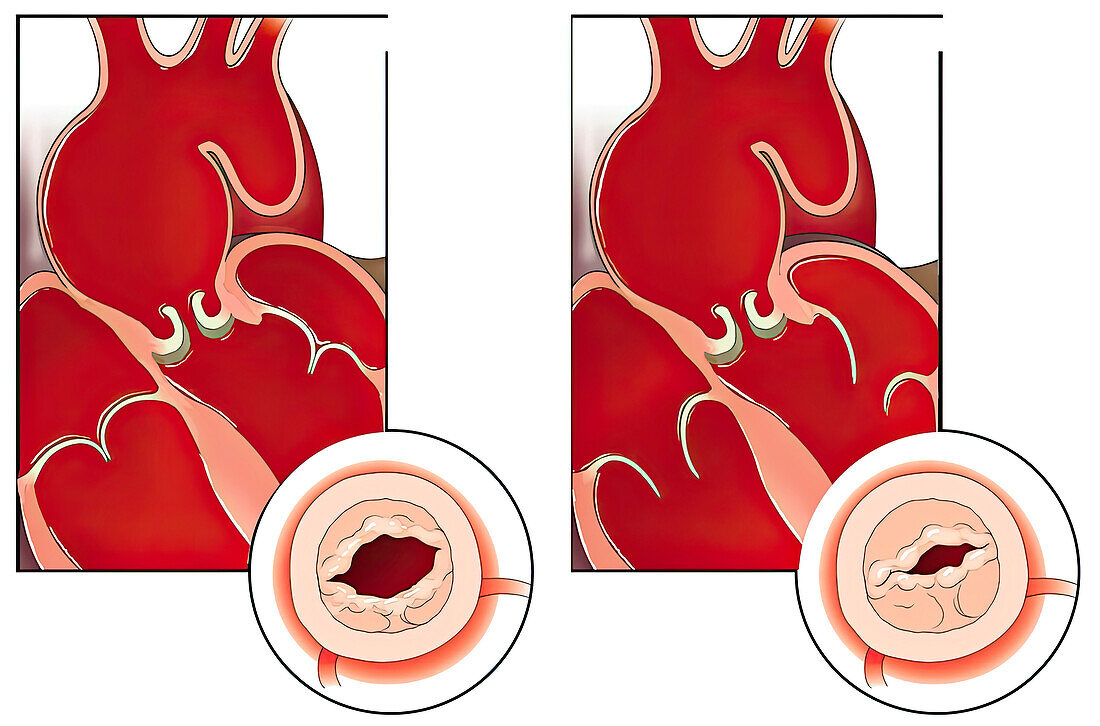 Poor aortic valve function, illustration