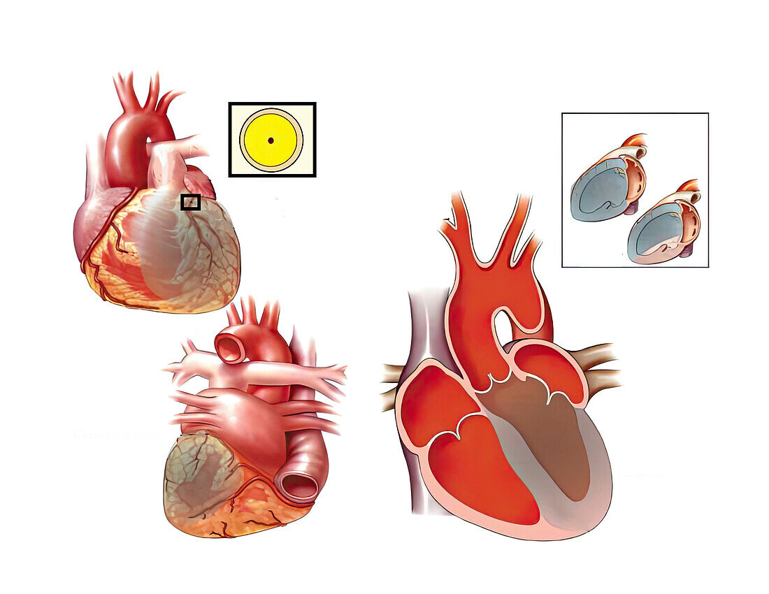 Left main coronary artery infarction, illustration