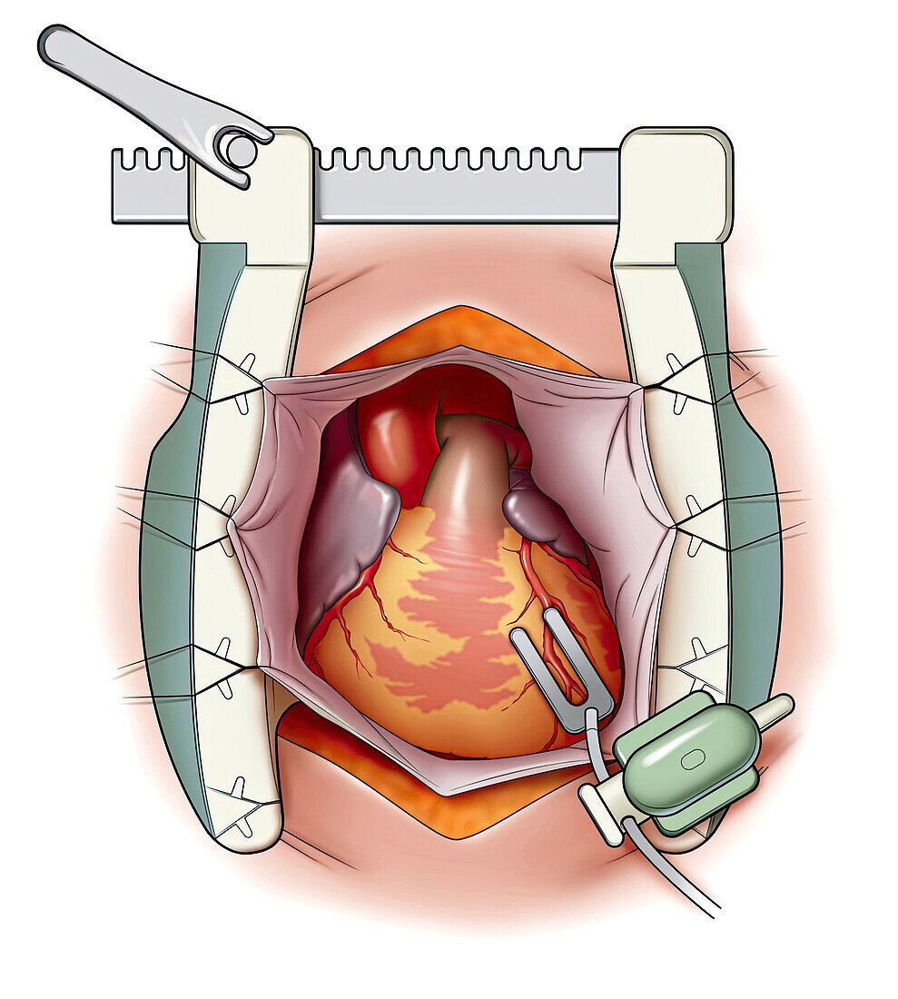 Bypass surgery, illustration