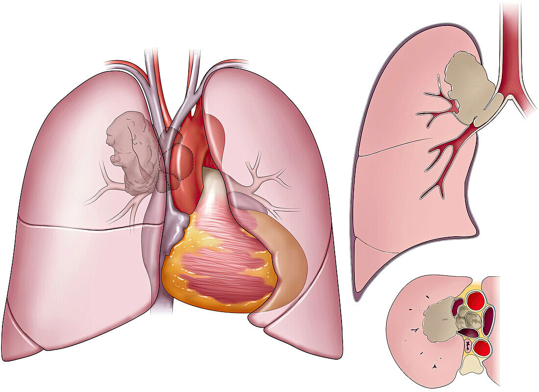 Mediastinal tumour, illustration