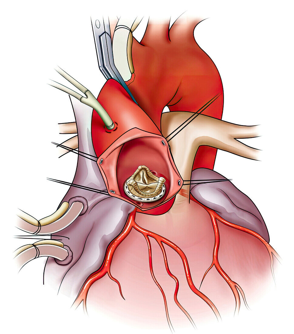 Valve surgery, illustration