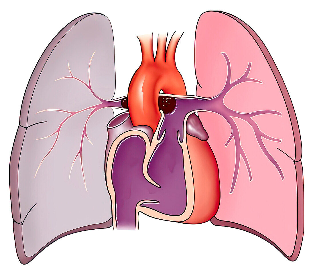 Saddle embolus with lung infarction, illustration