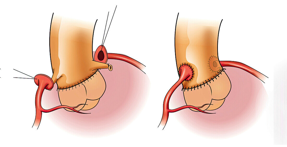 Attaching coronary arteries to aortic root graft, illustration
