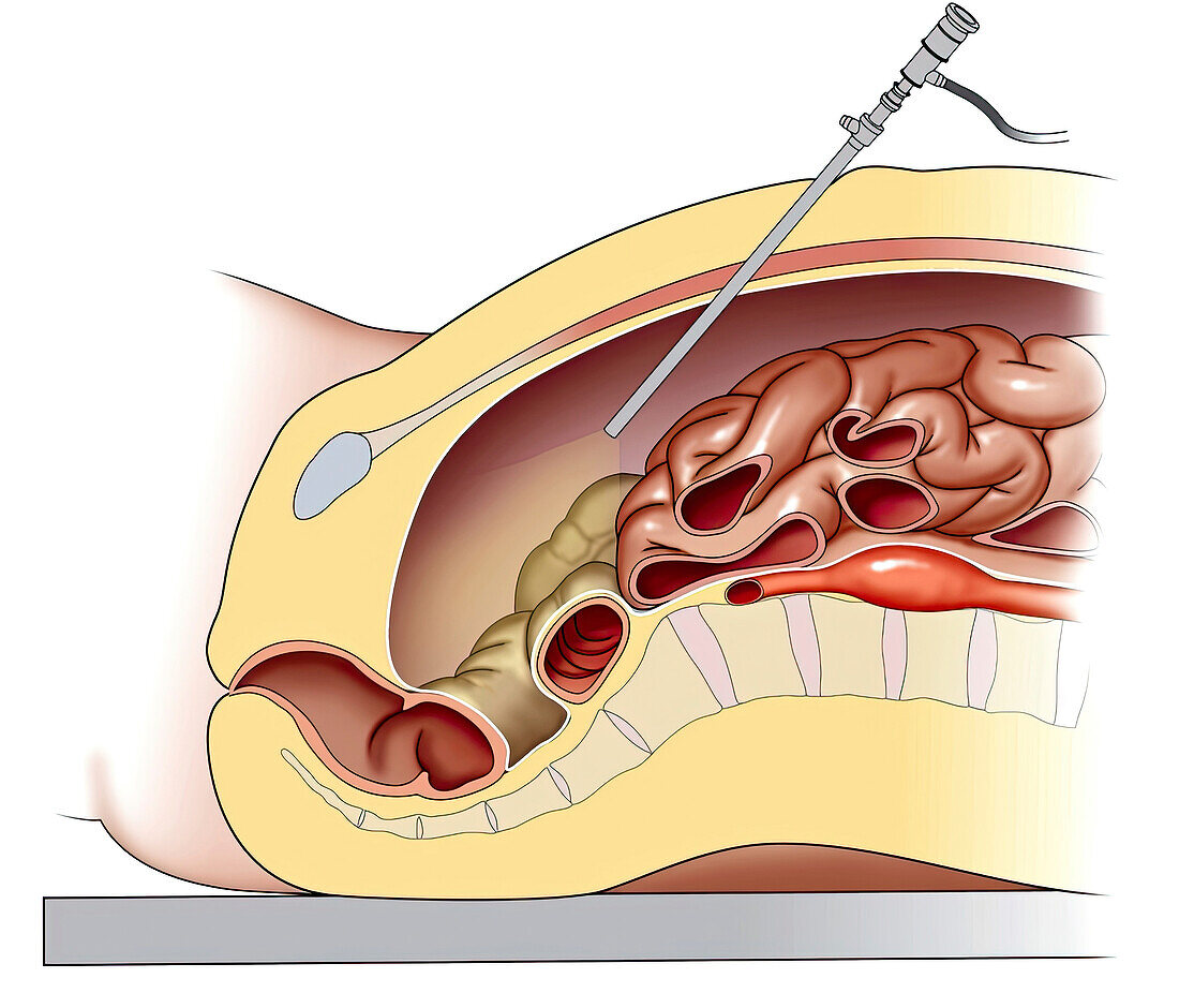 Small abdominal aortic aneurysm, illustration