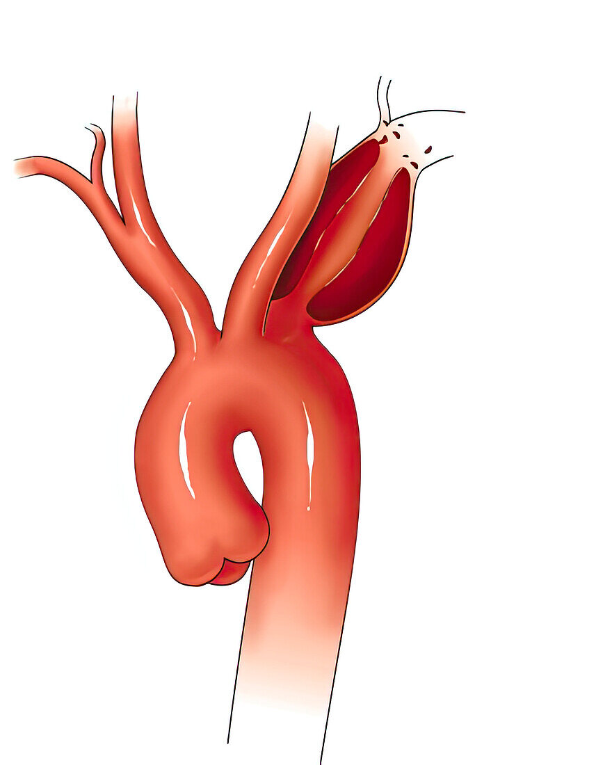 Subclavian artery aneurysm, illustration