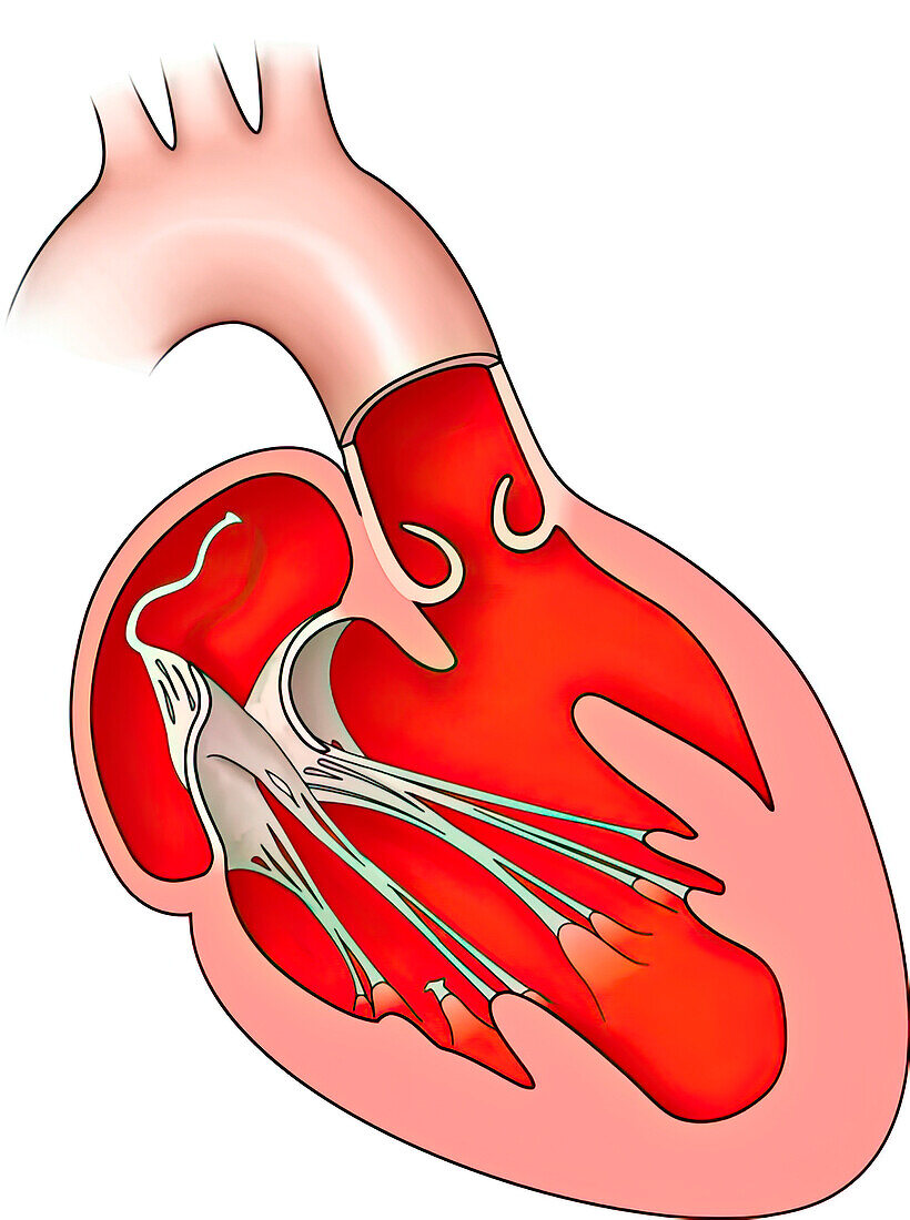 Hypoplastic left heart syndrome, illustration