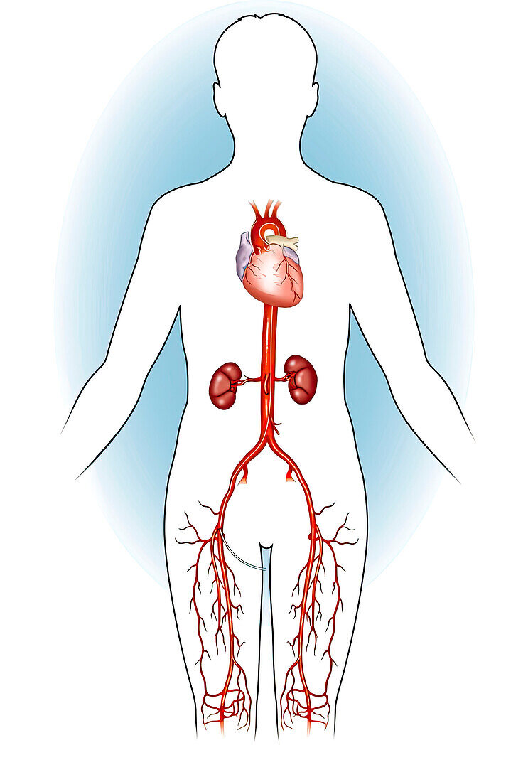 Major arteries of lower body, illustration