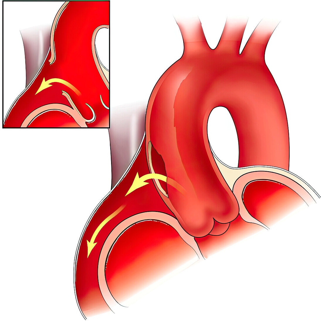 Aortic rupture , illustration