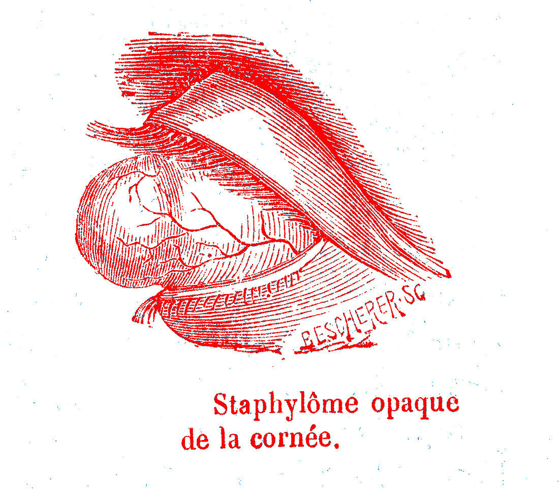 Staphyloma of the eye, 19th century illustration