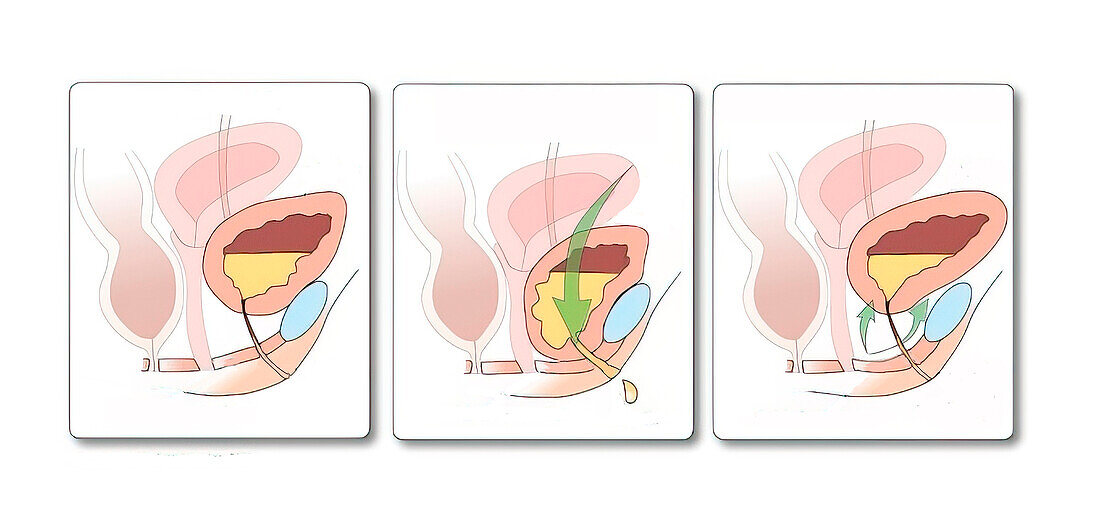 Stress urinary incontinence, illustration