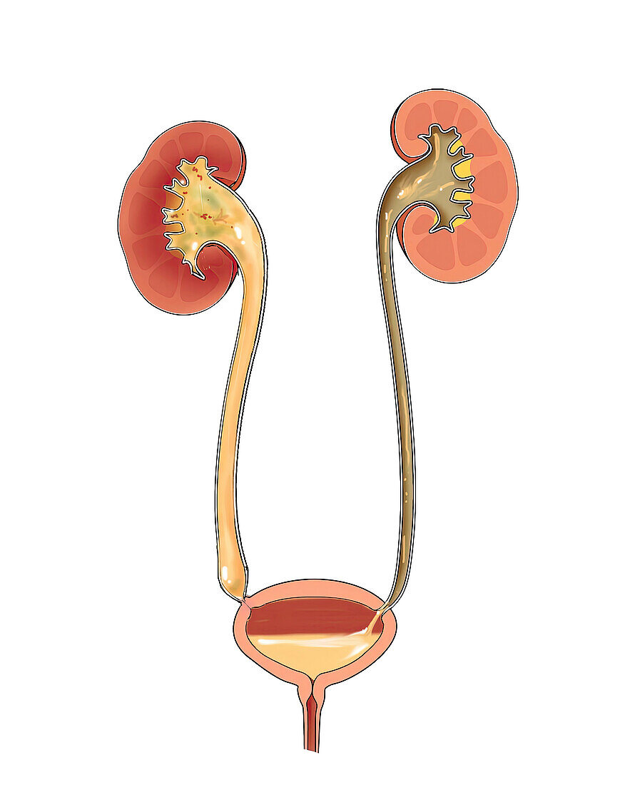 Ureterocystic reflux, illustration