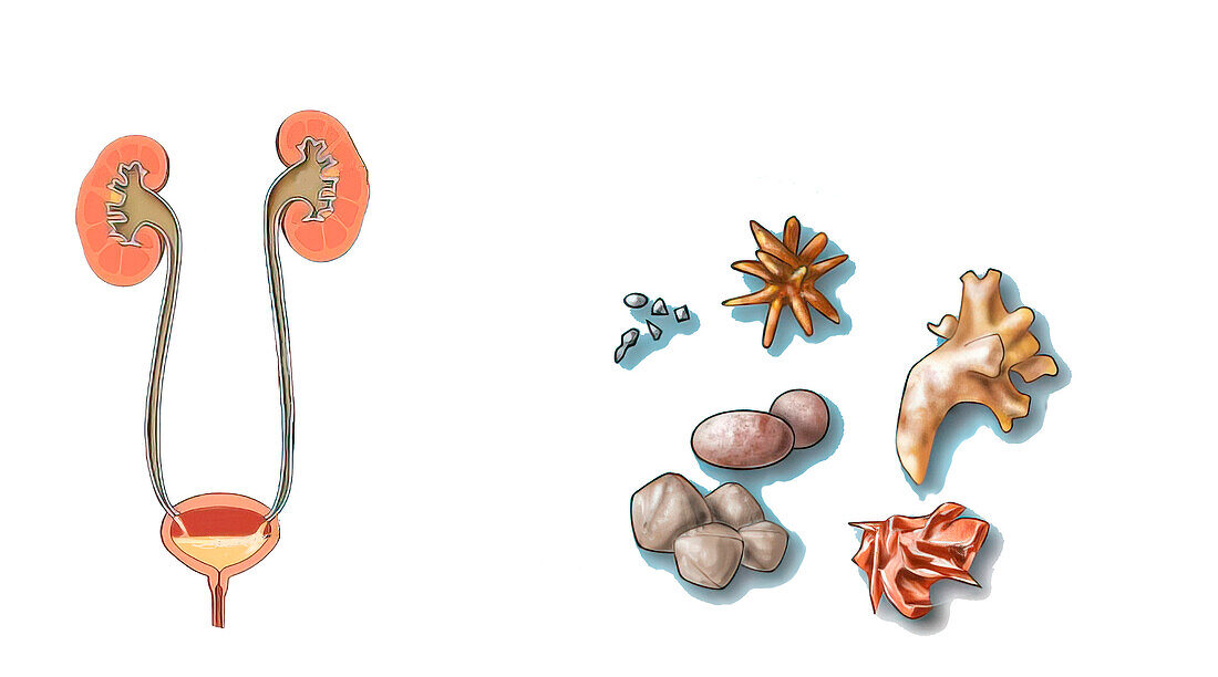 Kidney stones, illustration