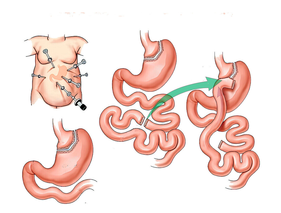 Laparoscopic gastric bypass, illustration