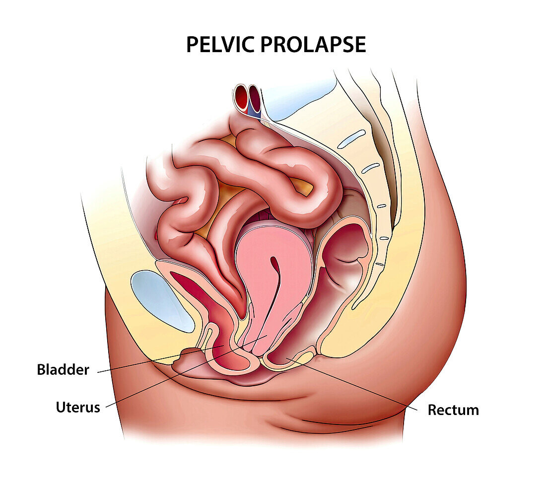Pelvic prolapse, illustration
