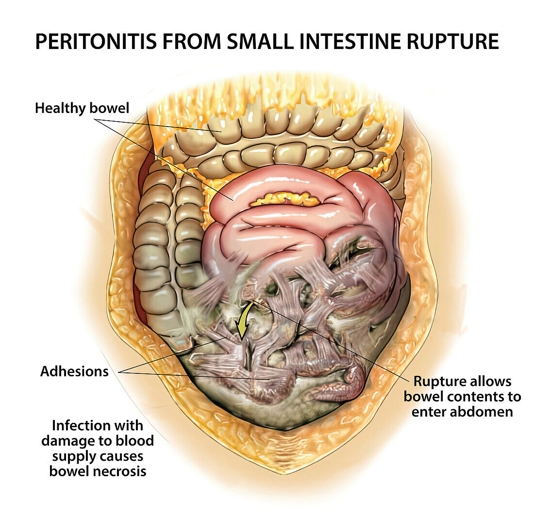 Peritonitis from ruptured bowel, illustration