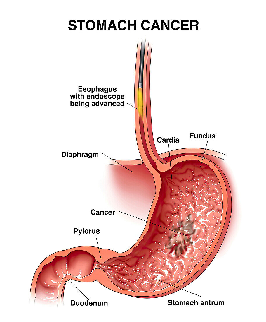 Stomach cancer with esophagoscope, illustration