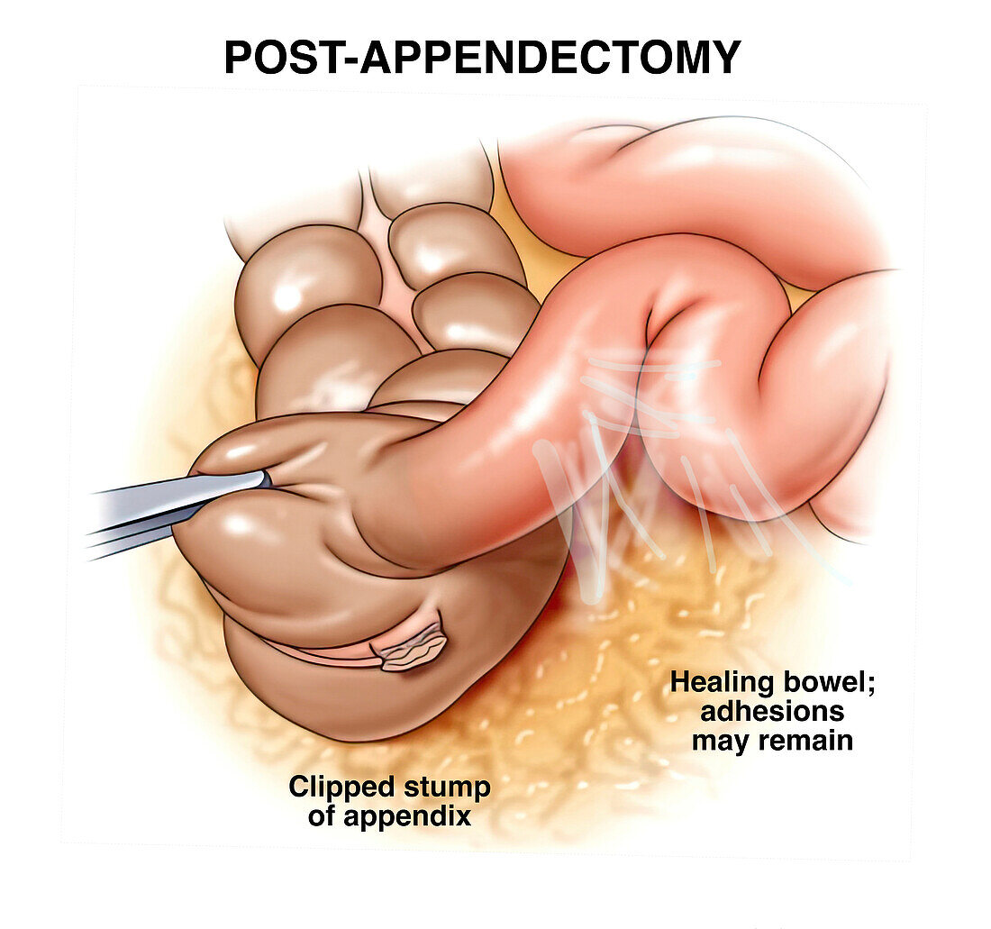 Appendicitis, illustration