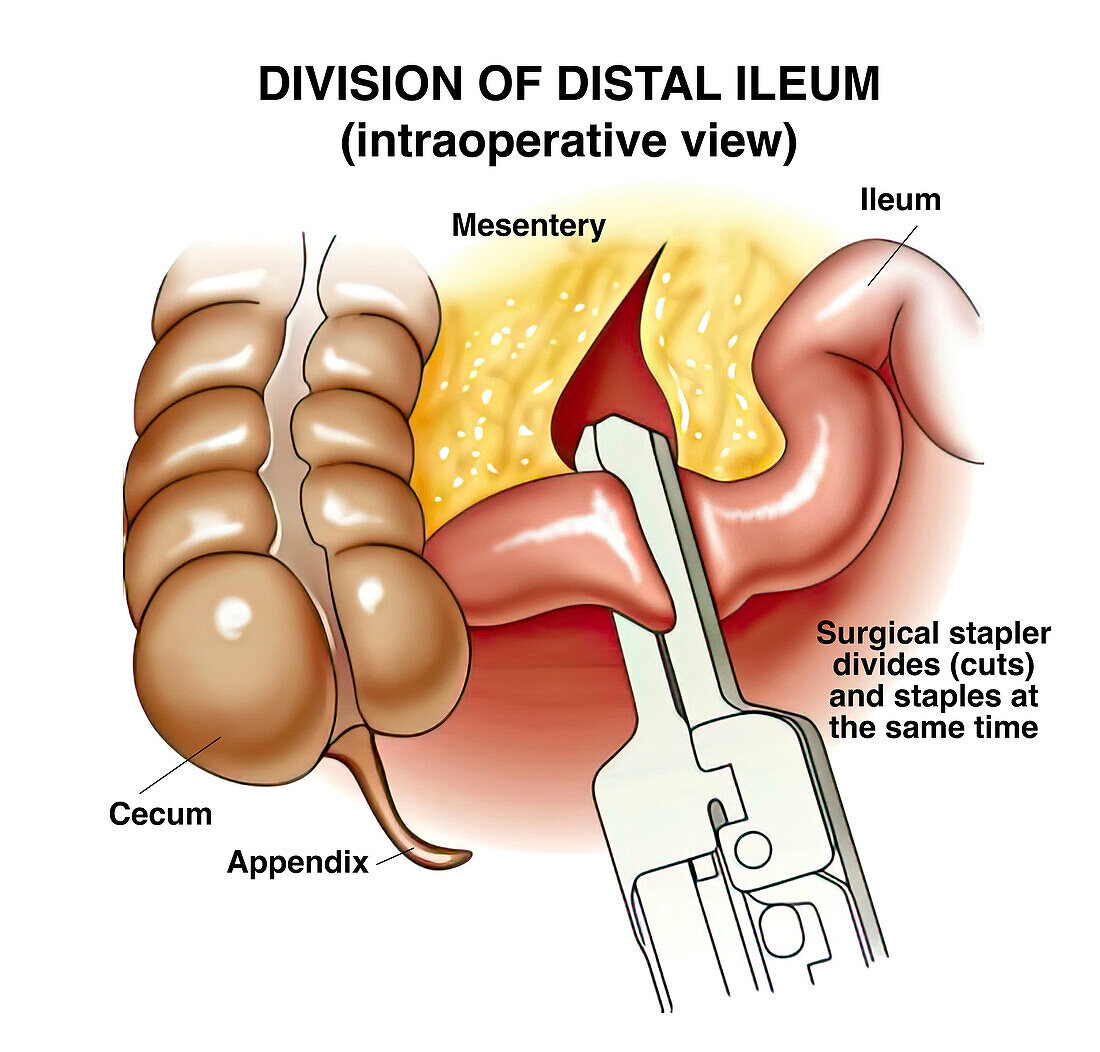 Division of distal ileum, illustration