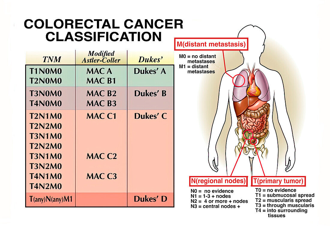 Colorectal cancer classification, illustration