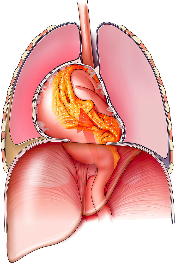 Hiatal hernia, illustration