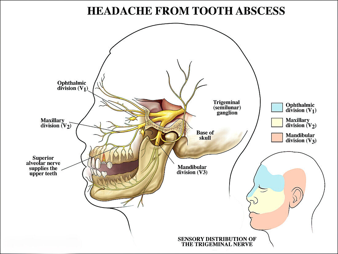 Trigeminal nerve and tooth pain, illustration