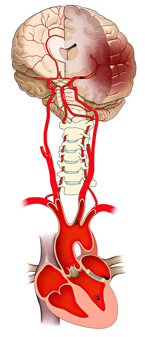 Embolic stroke with mitral valve replacement, illustration