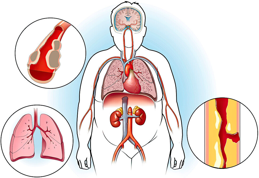 Severe atherosclerosis, illustration