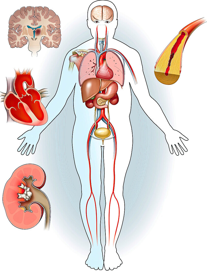 Embolic infarcts, illustration