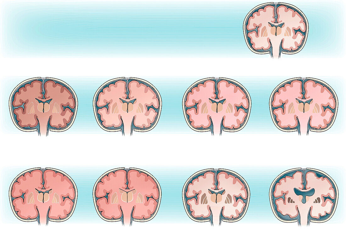 Anoxic brain injury, illustration