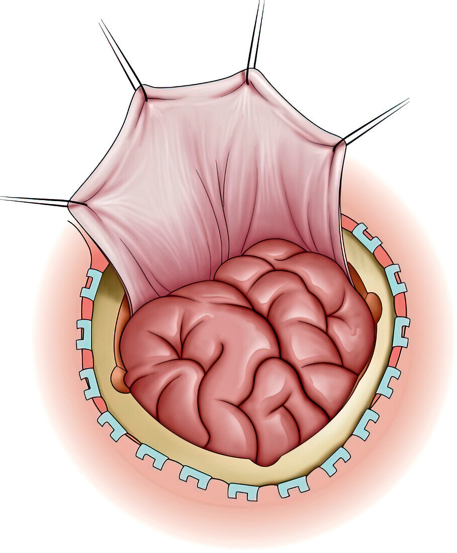 Surgical exposure of brain, illustration