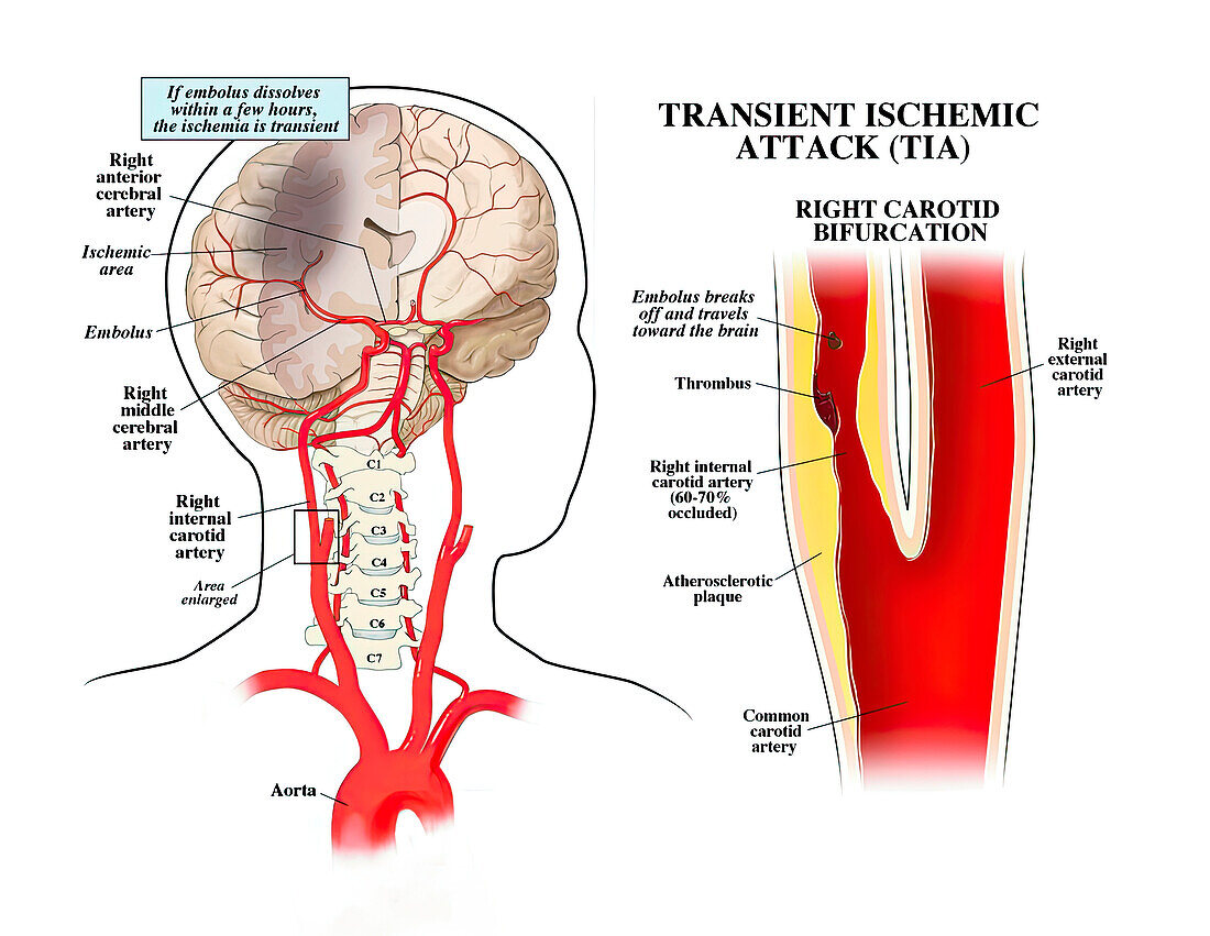 Carotid artery disease and stroke, illustration