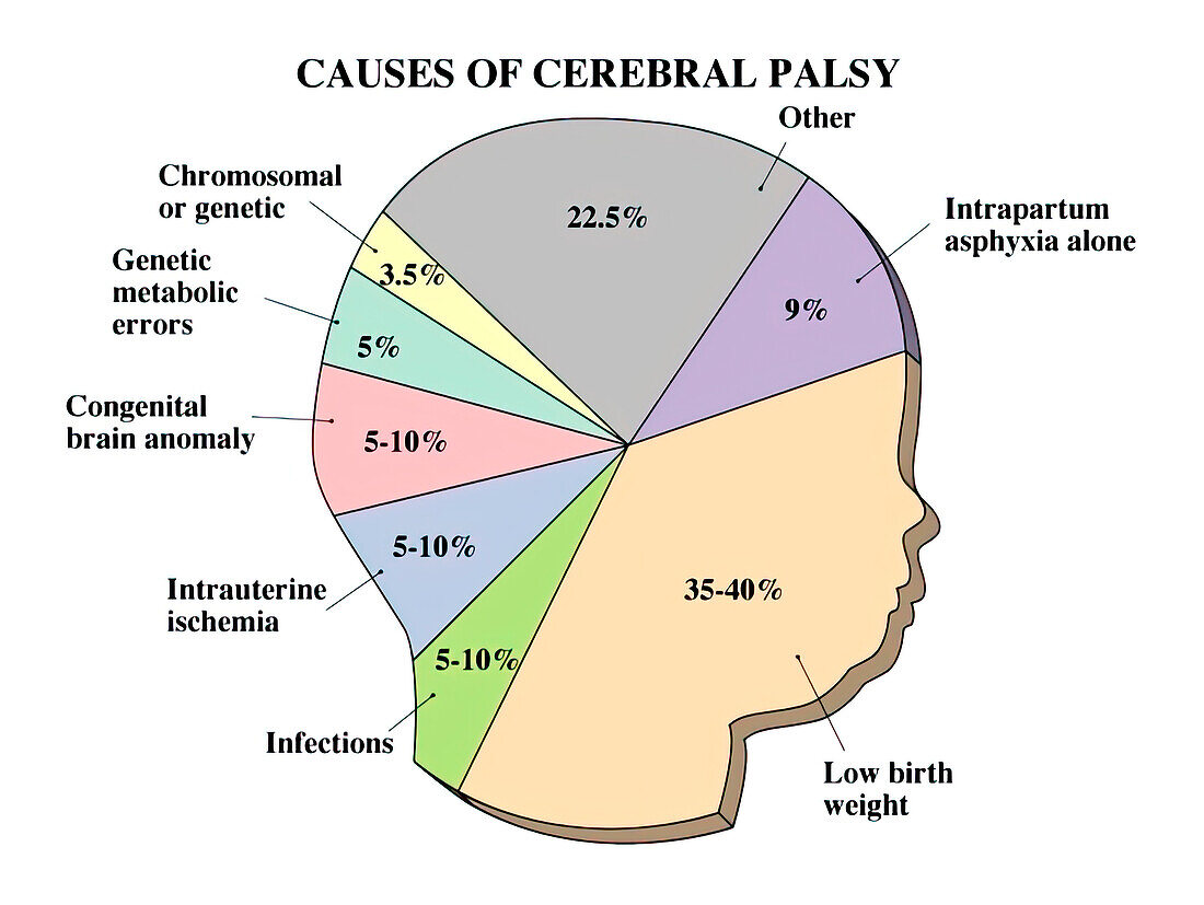 Causes of cerebral palsy, illustration