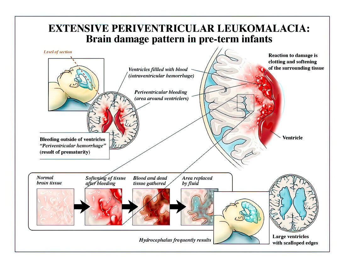 Periventricular leukomalacia, illustration