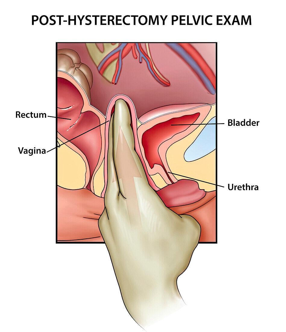 Post-hysterectomy pelvic exam, illustration