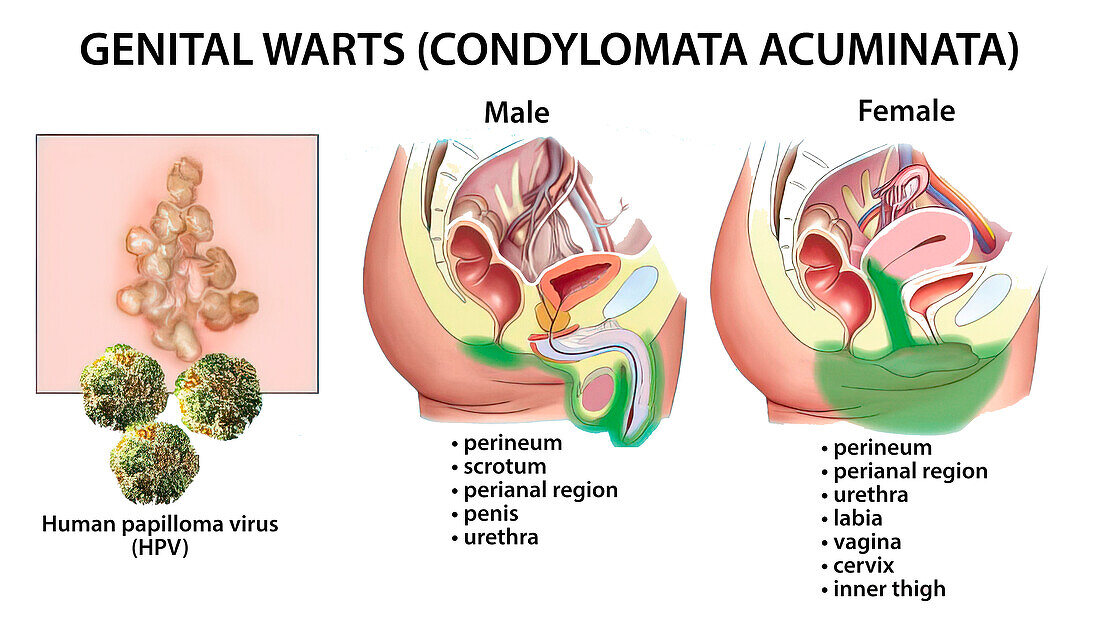 Genital warts, illustration
