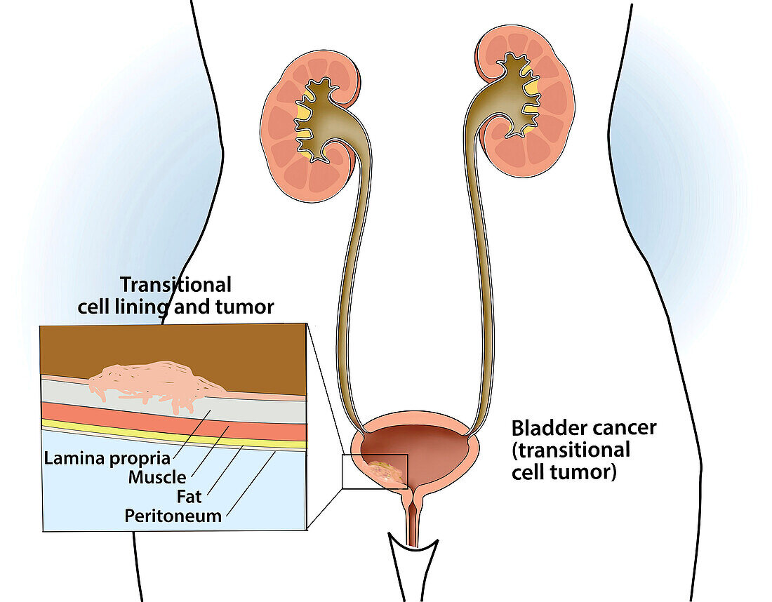 Transitional cell cancer, illustration