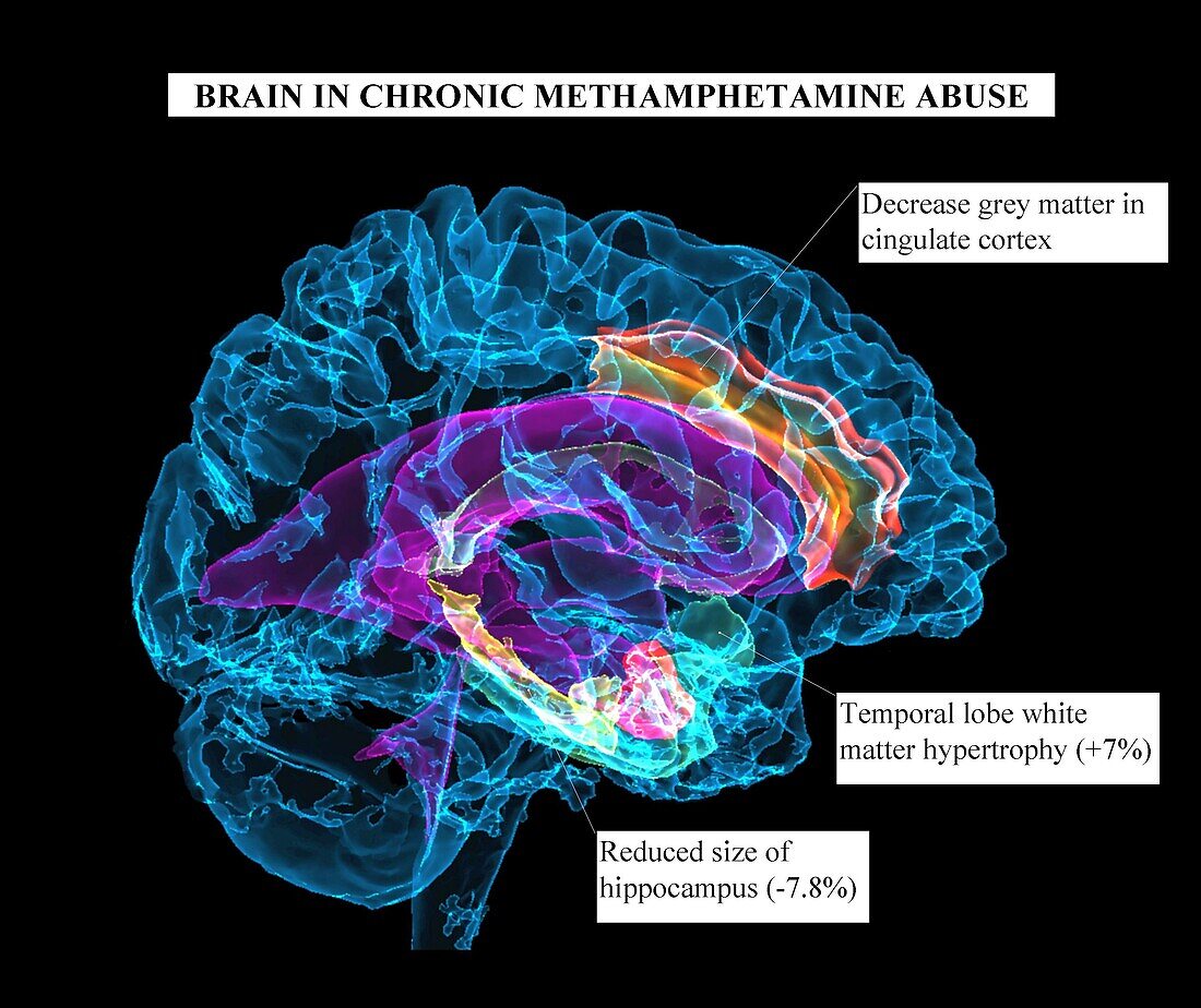 Brain affected by chronic methamphetamine abuse, MRI scan