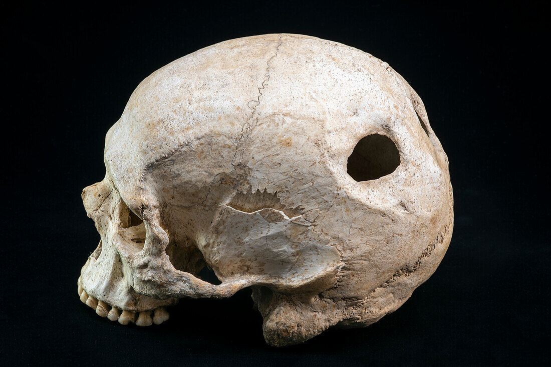 Neolithic human skull with signs of surgery