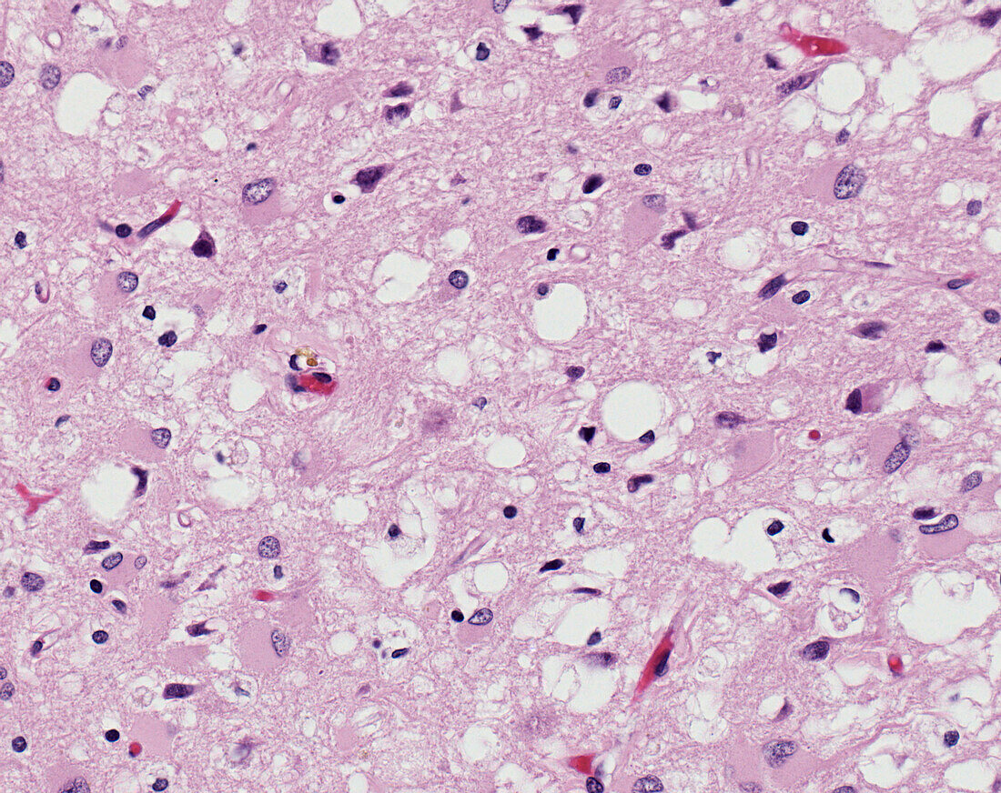 Brain in Creutzfeldt-Jakob disease, light micrograph