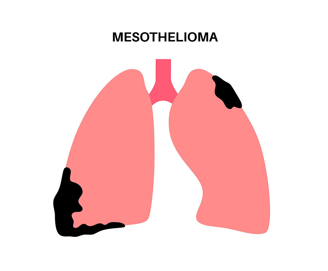 Mesothelioma cancer disease, illustration