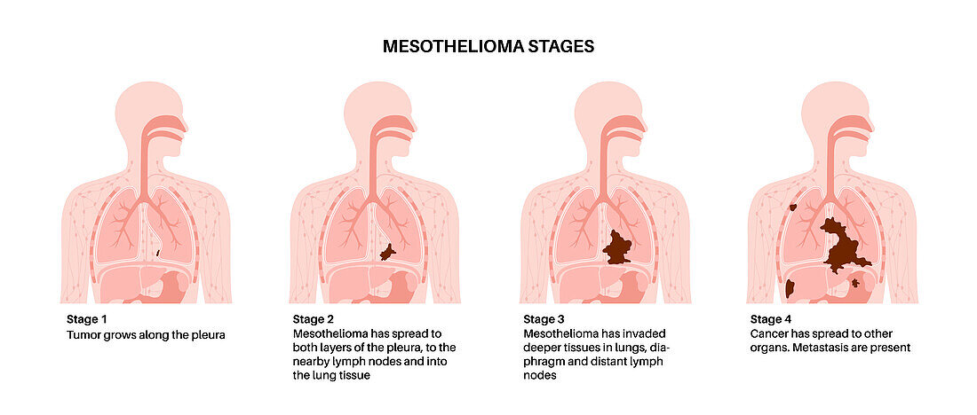 Mesothelioma cancer stages, illustration