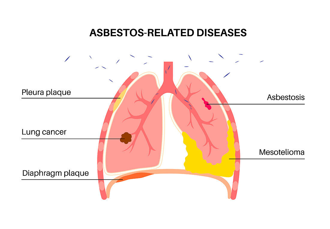 Asbestos related diseases, illustration