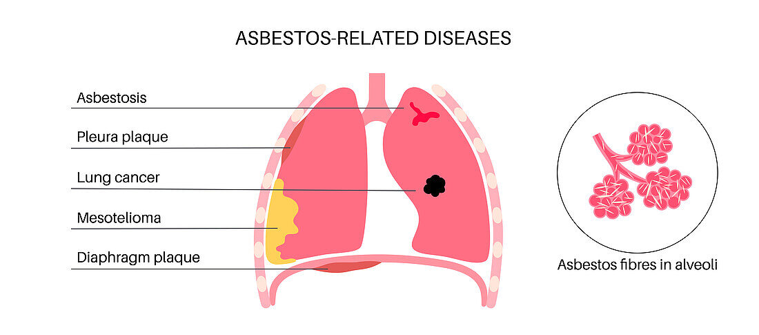 Asbestos related diseases, illustration